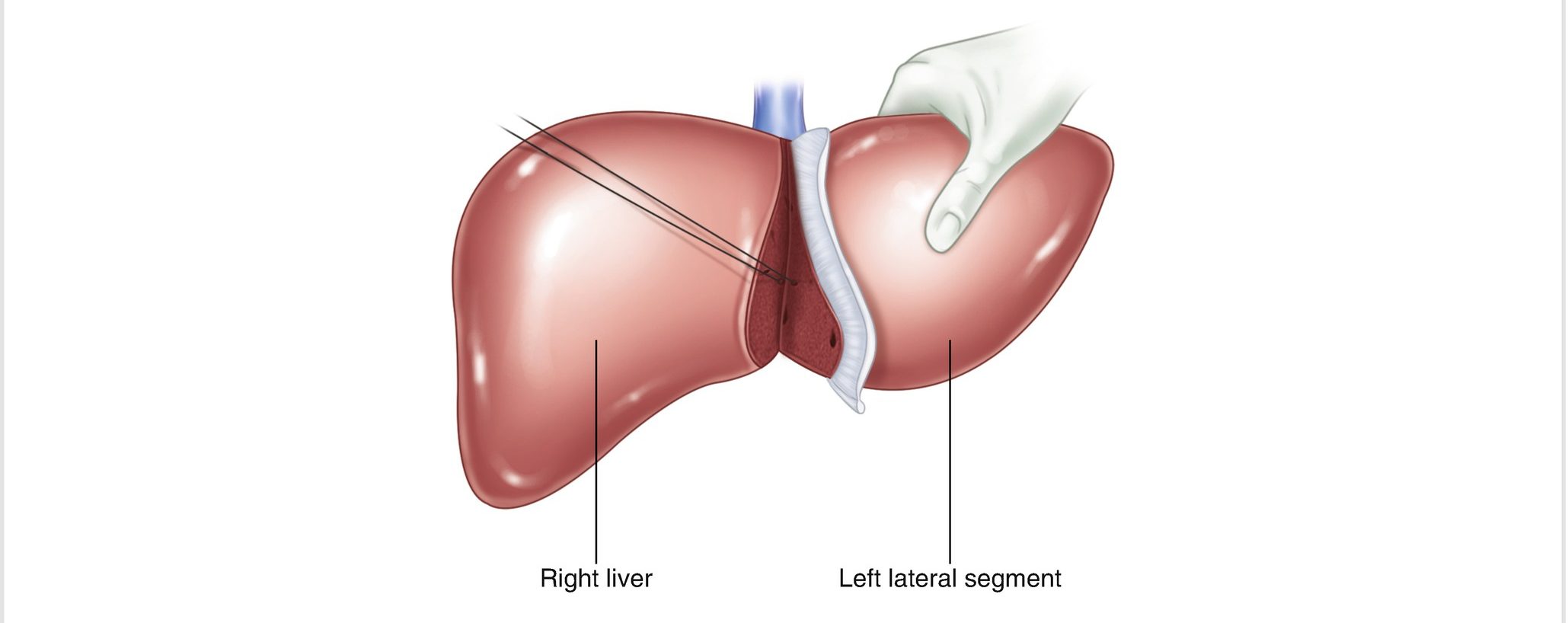 liver transplant procedure