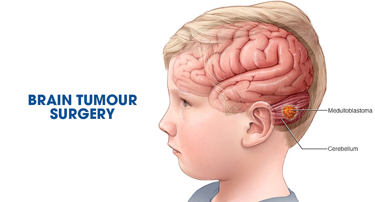 الجراحة العصبية لـ اورام الدماغ