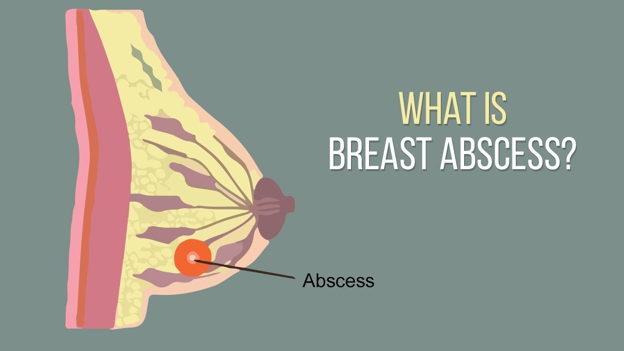 Breast surgery