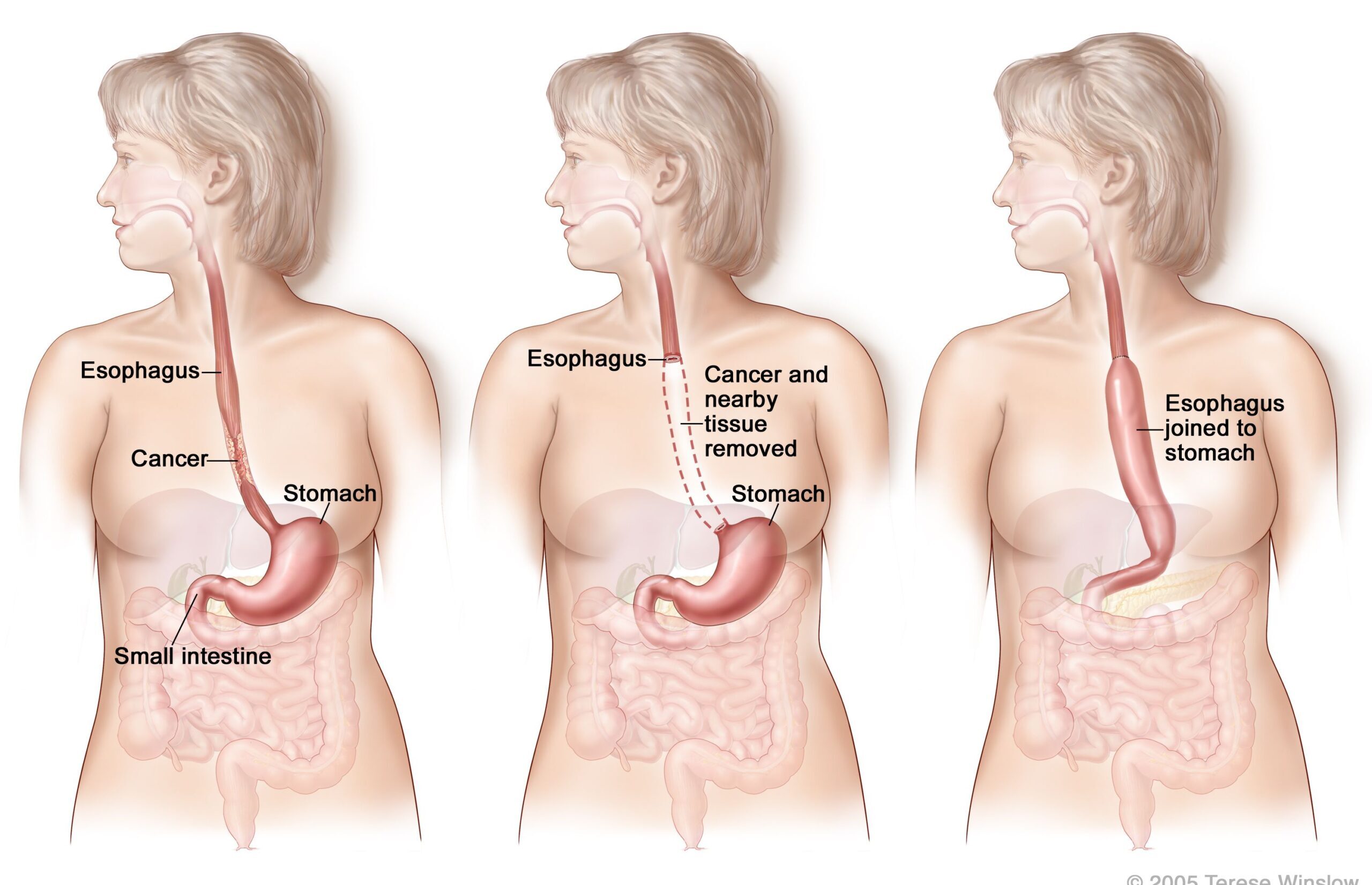 Esophageal operations