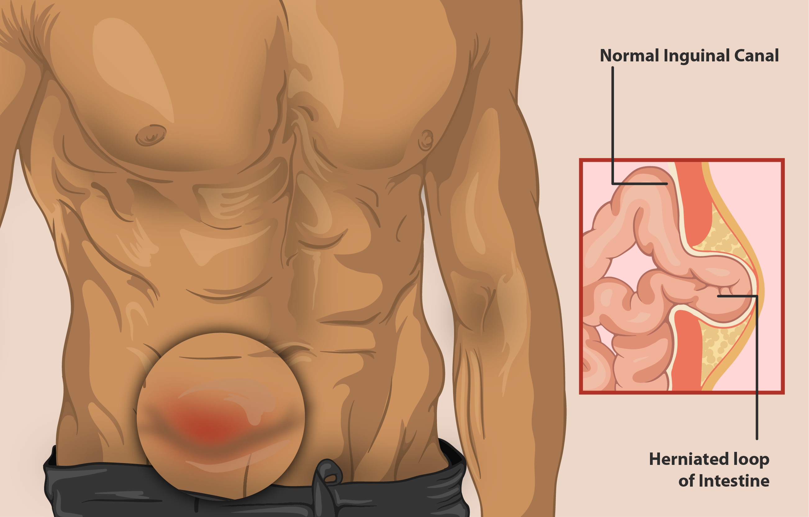 inguinal hernia repair surgery