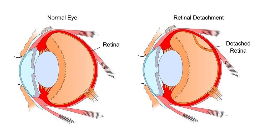 retinal detachment treatment