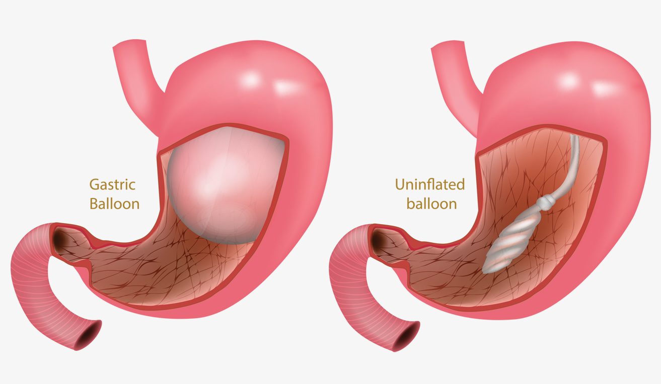 balloon gastric procedure