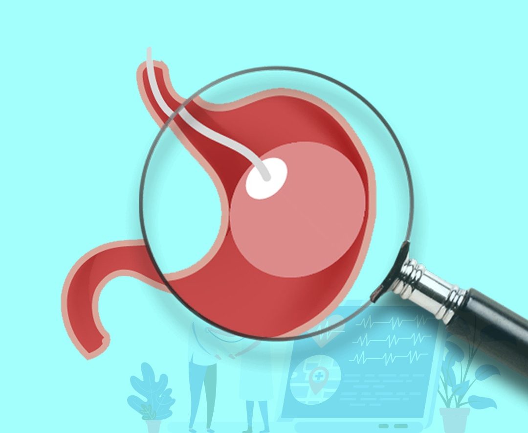 Balloon Gastric Procedure and All about it | Healing Consulting Turkey