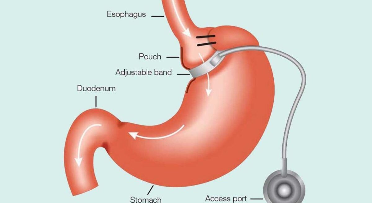 stomach band