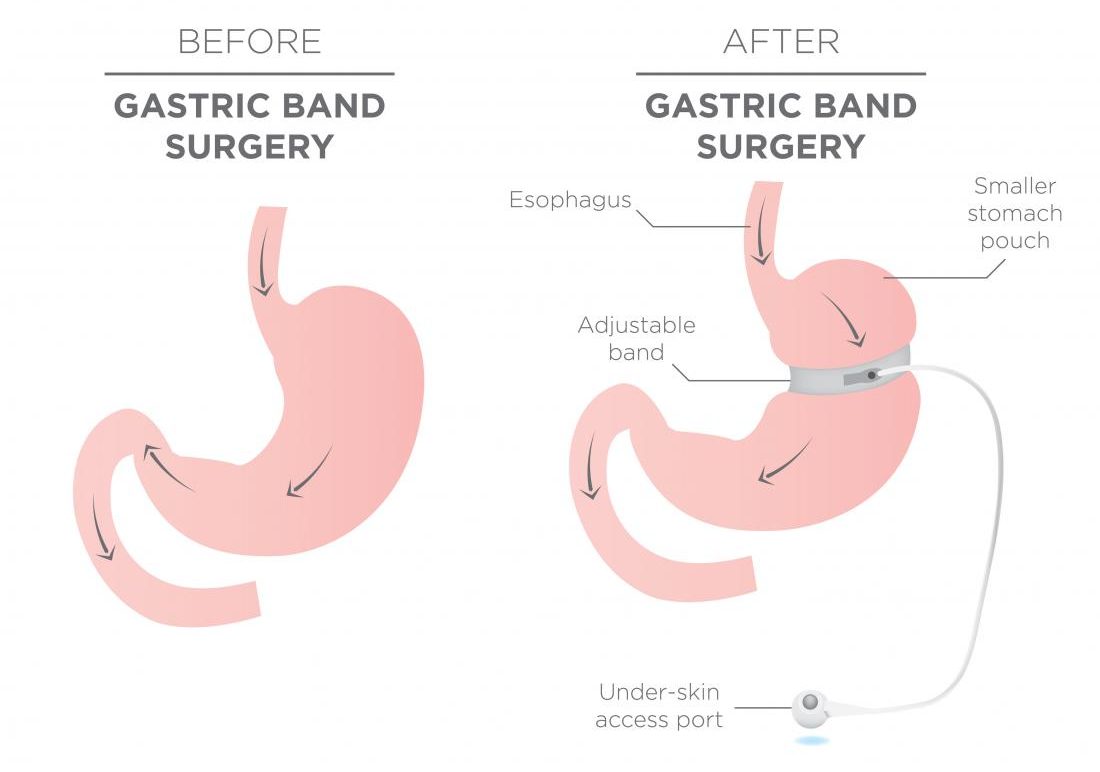 gastric banding procedure