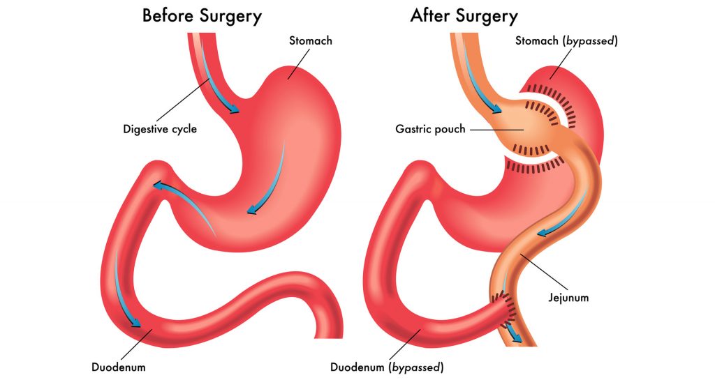 Roux En Y Procedure and All about it | Healing Consulting Turkey