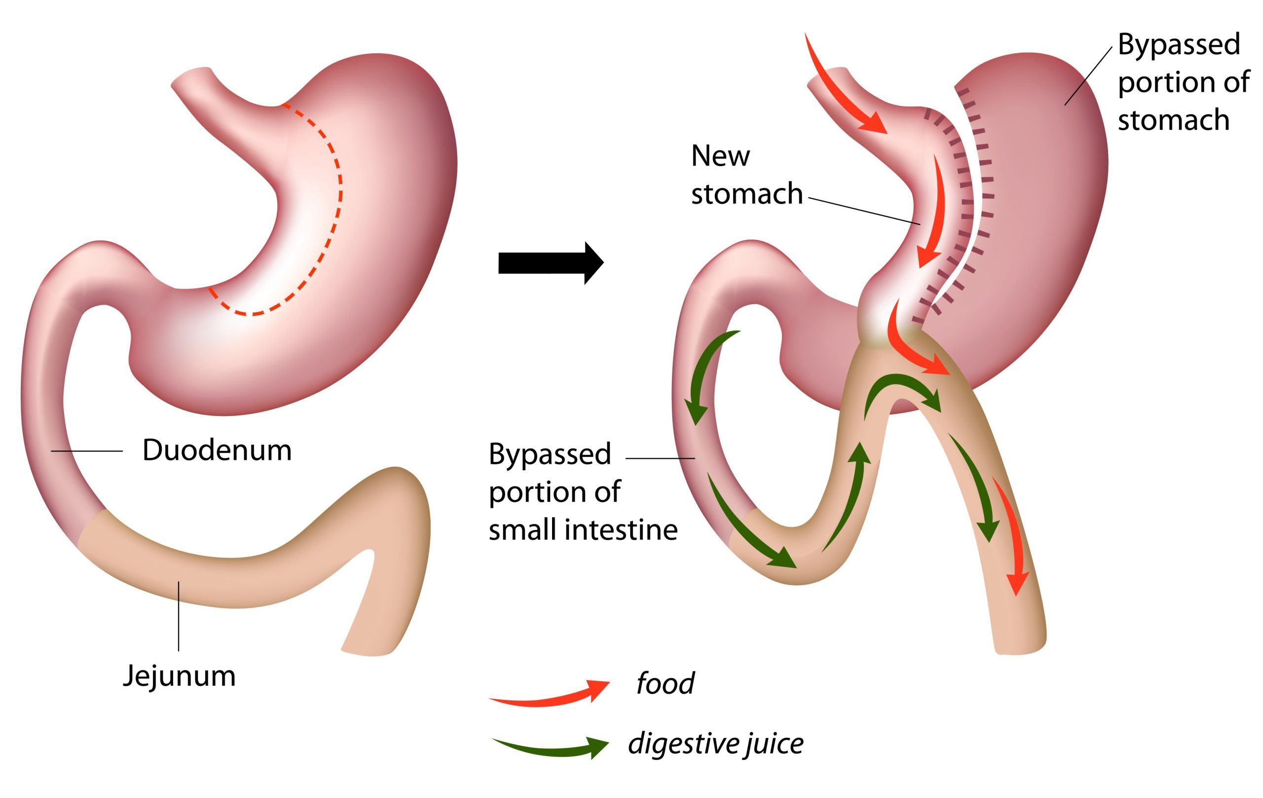 roux en y procedure