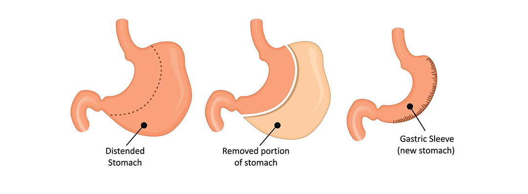 sleeve gastrectomy procedure