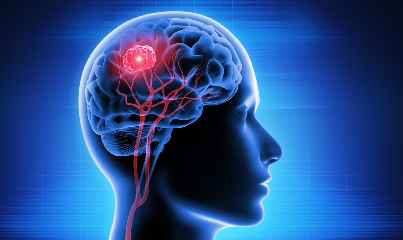 أعراض أورام المخ والاعصاب