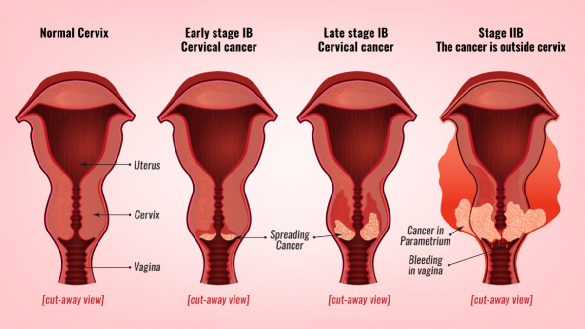 اعراض سرطان عنق الرحم