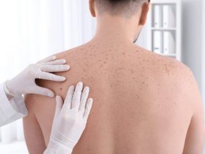 اعراض سرطان الجلد