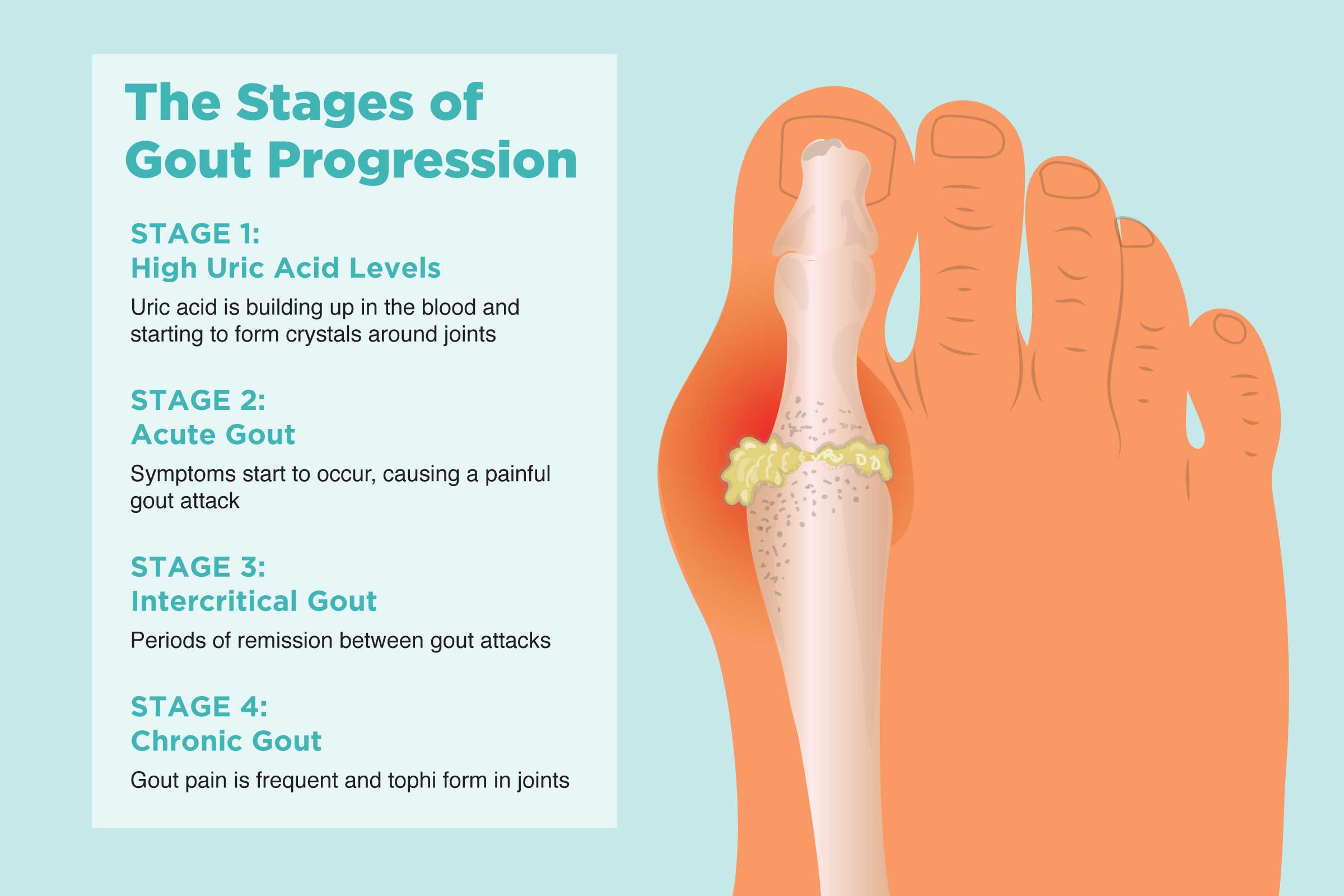 How is gout diagnosed